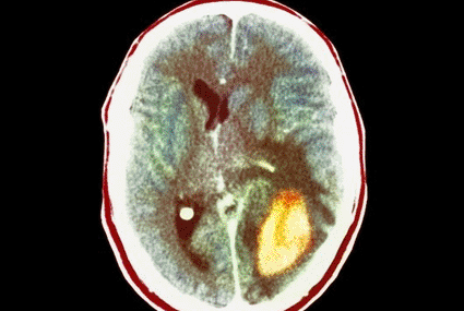 Image: Colored computed tomography (CT) scan in axial section through the head of a 38-year-old man with a malignant, rapidly growing glioma brain tumor (yellow, at lower right) (photo courtesy Science Photo Library).